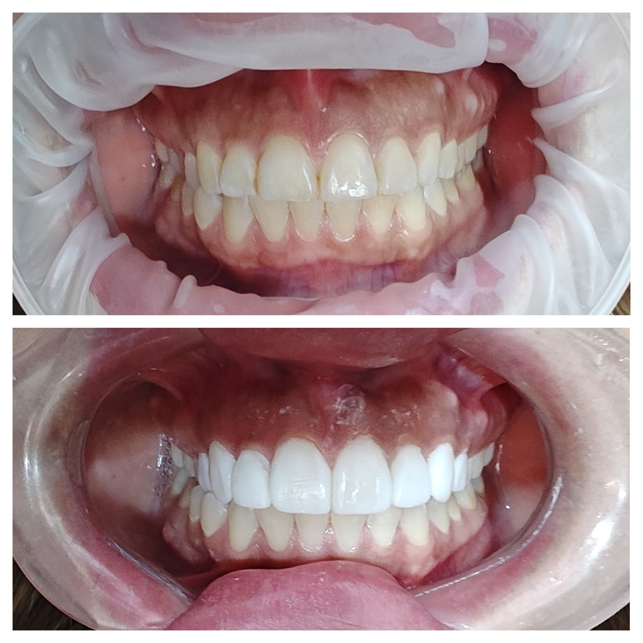 Diseño de sonrisas - Antes y después