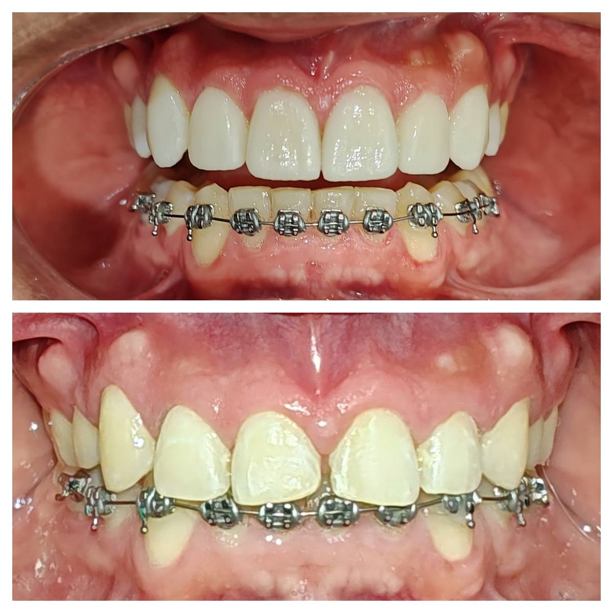 Tratamiento de ortodoncia con brackets